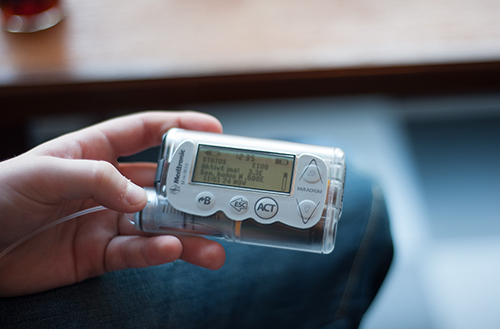 Insulinpump förbättrar överlevnad hos personer med typ 1-diabetes